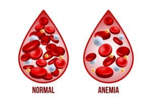 Anemia