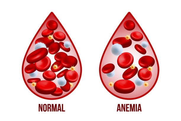 Anemia: Types, Symptoms, Causes, and Treatment