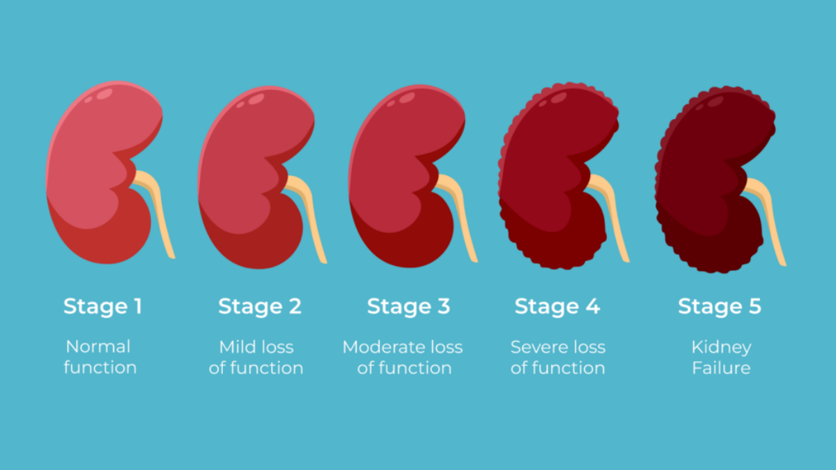 Chronic Kidney Disease: Stages, Symptoms, and Management
