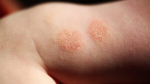 Eczema and Psoriasis Treatment