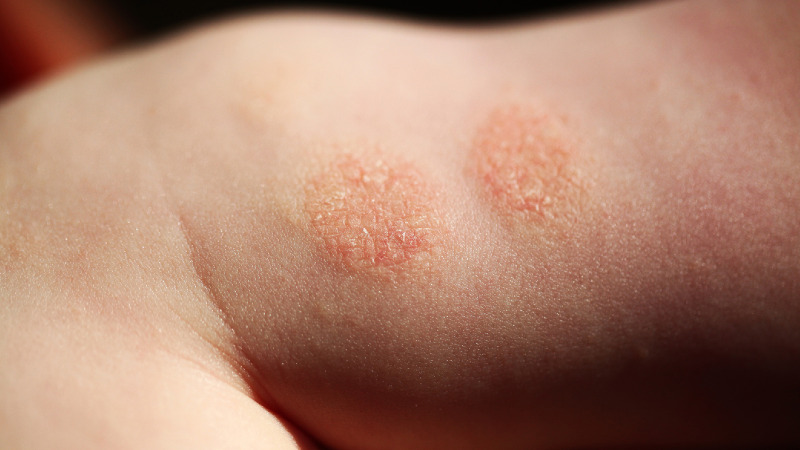 Eczema and Psoriasis Treatment Guide: 7 Proven Ways to Relieve Symptoms Before They Worsen