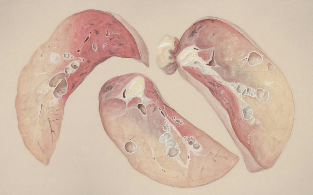 Pneumonia Symptoms, Causes, Risk Factors, and Treatment lung infection diagram