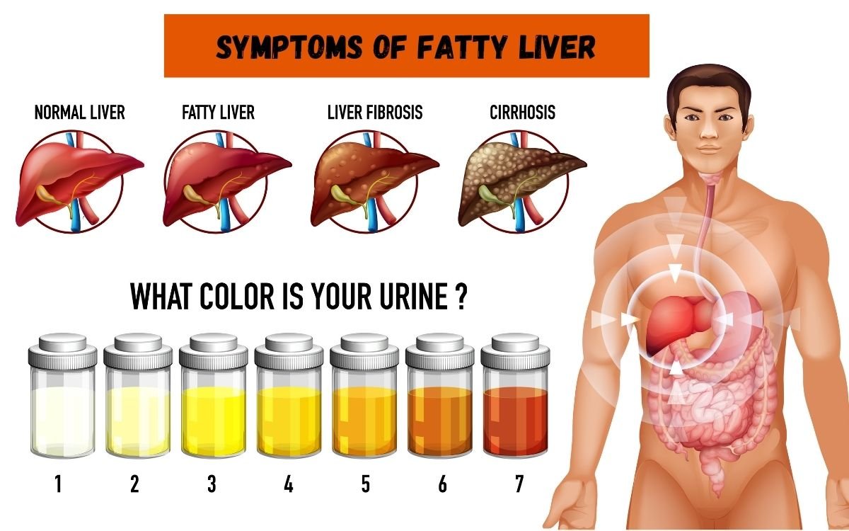 Fatty Liver Disease Symptoms and Treatment guide explaining causes, stages, diagnosis, and liver health management