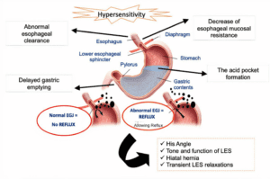 GERD Symptoms and Treatment guide explaining acid reflux causes, diagnosis, treatment, and prevention