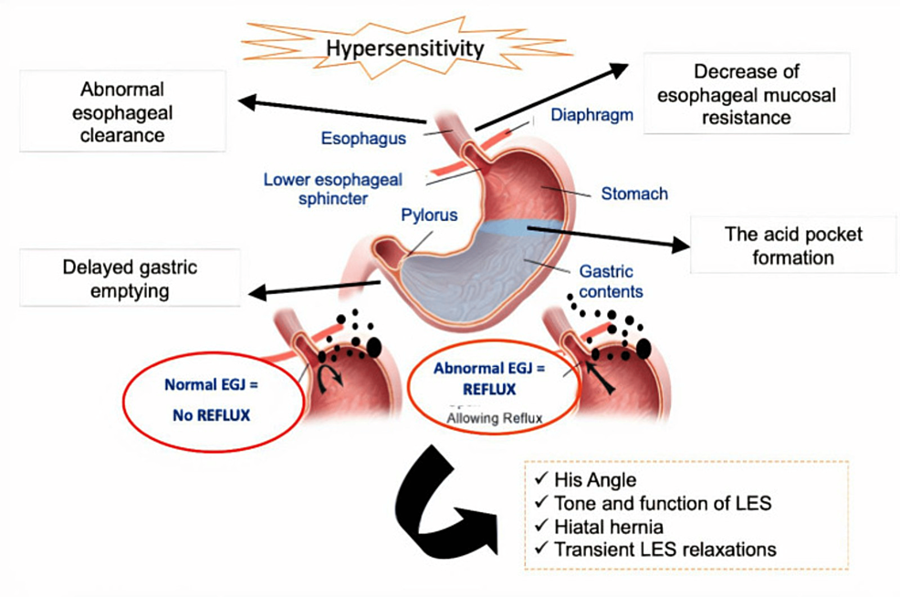 GERD Symptoms and Treatment: Causes, Diagnosis & Prevention