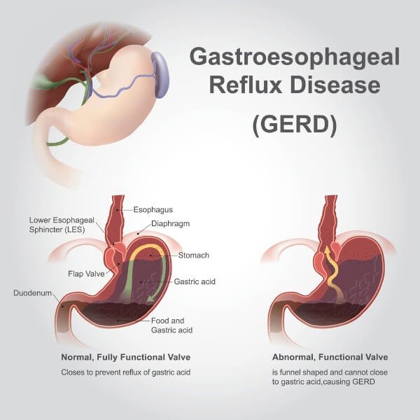 GERD Symptoms and Treatment guide explaining acid reflux causes, diagnosis, treatment, and prevention