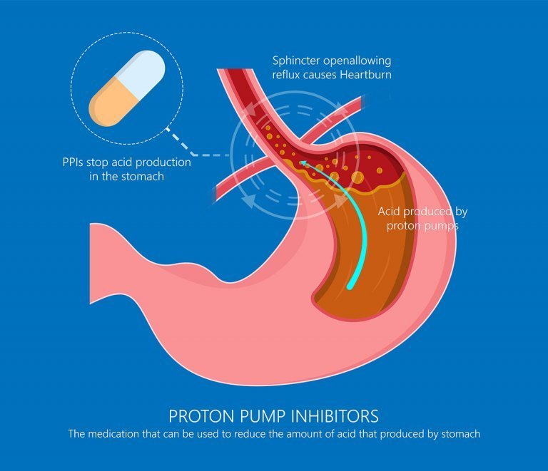 GERD Symptoms and Treatment guide explaining acid reflux causes, diagnosis, treatment, and prevention
