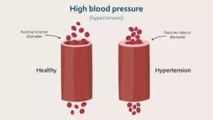 Hypertension Symptoms and Treatment guide explaining causes, diagnosis, and blood pressure management