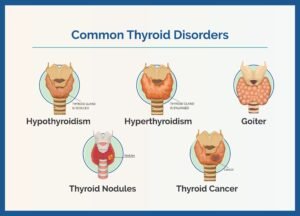 Thyroid Disorders Symptoms and Treatment guide comparing hypothyroidism and hyperthyroidism
