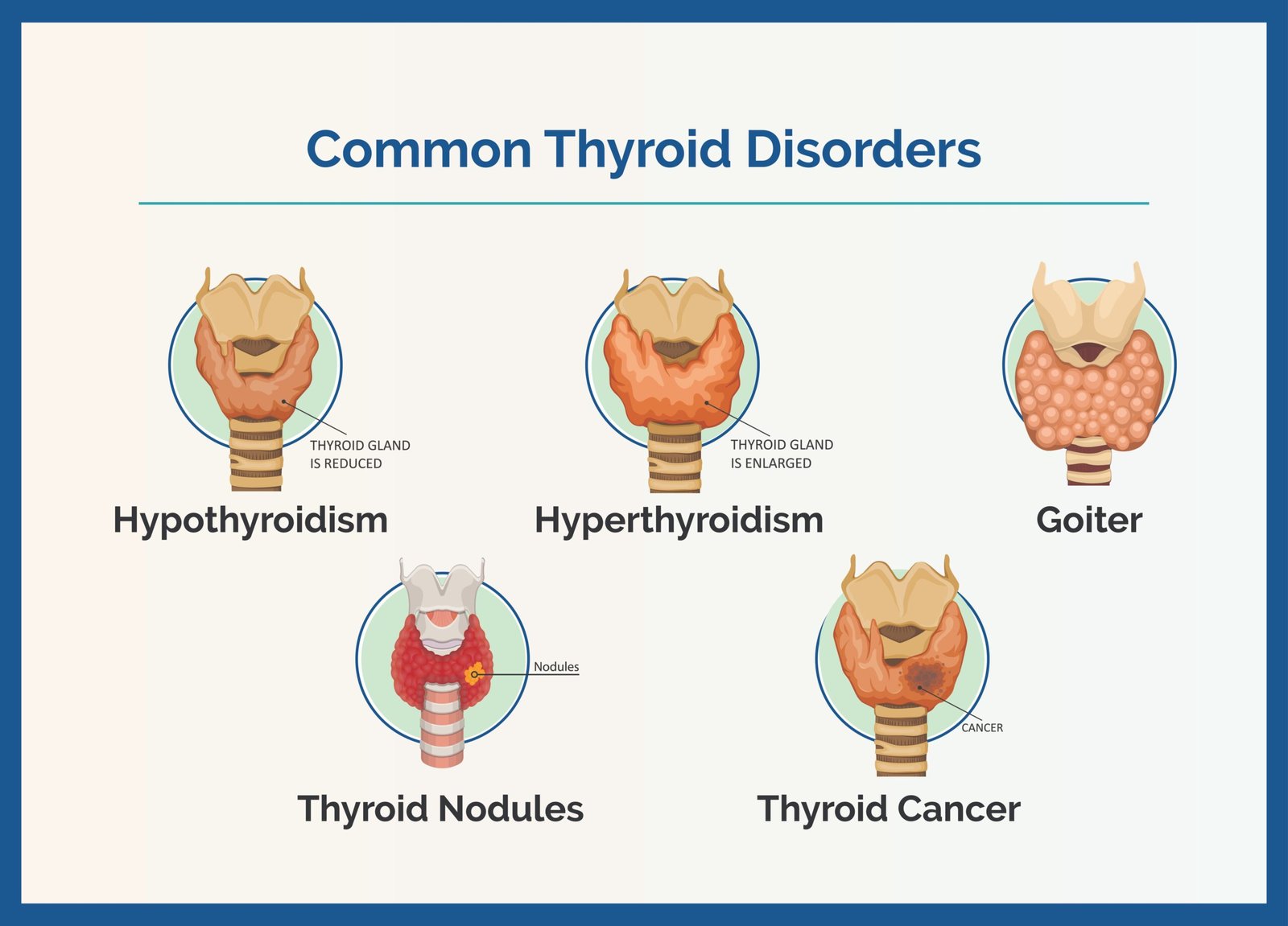 Thyroid Disorders Symptoms and Treatment: Hypothyroidism vs Hyperthyroidism