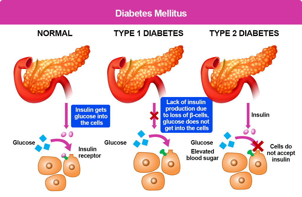 Managing Type 2 Diabetes after 60: Diet, Exercise, Medication and Blood Sugar Tips