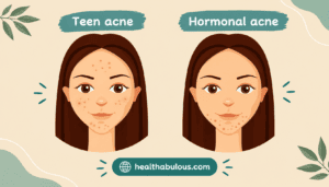 Acne in Women